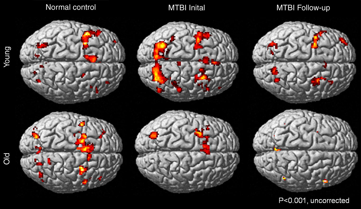 rsna-older-patients-recover-more-slowly-from-concussion